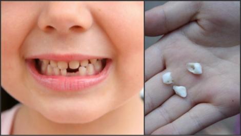 Dinţii căzuţi de la copii sunt „Comori de aur”! Motivul pentru care să nu-i arunci