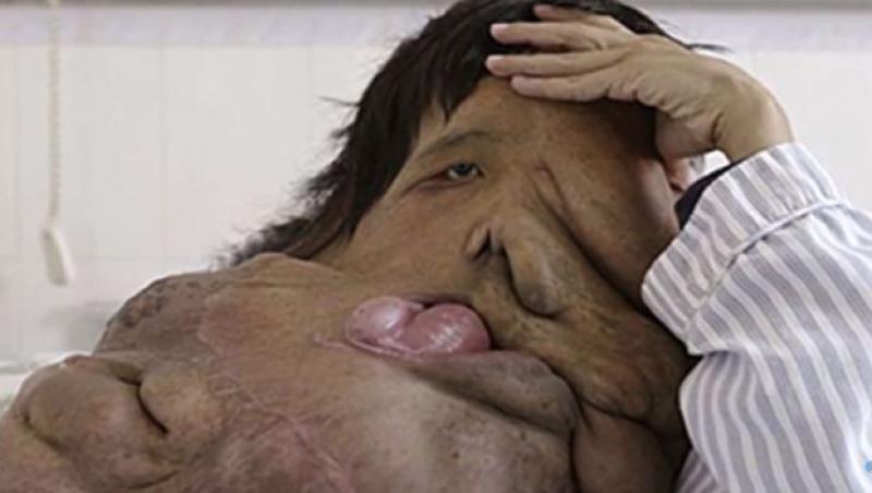 Imagini IREALE cu „Omul-elefant”. O tumoră gigantică l-a transformat pe un chinez într-o ciudățenie a naturii!