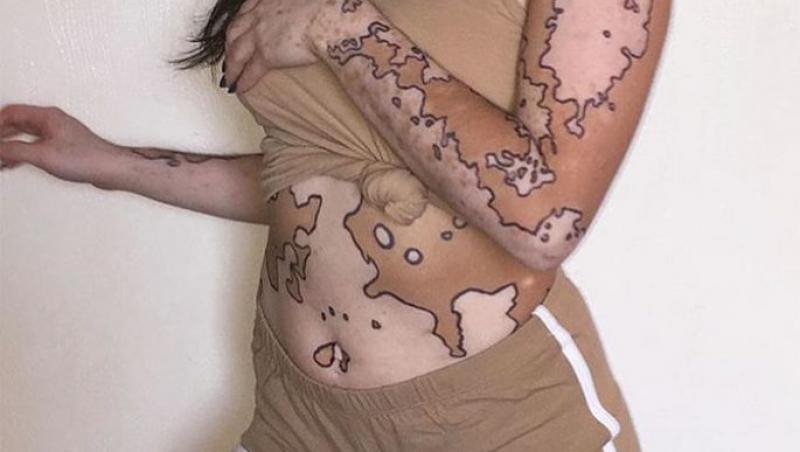A făcut artă din boala de care suferă! O tânără bolnavă de vitiligo și-a transformat trupul într-o hartă, după ce oamenii au râs de ea