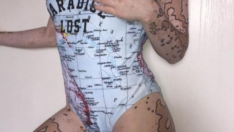 A făcut artă din boala de care suferă! O tânără bolnavă de vitiligo și-a transformat trupul într-o hartă, după ce oamenii au râs de ea
