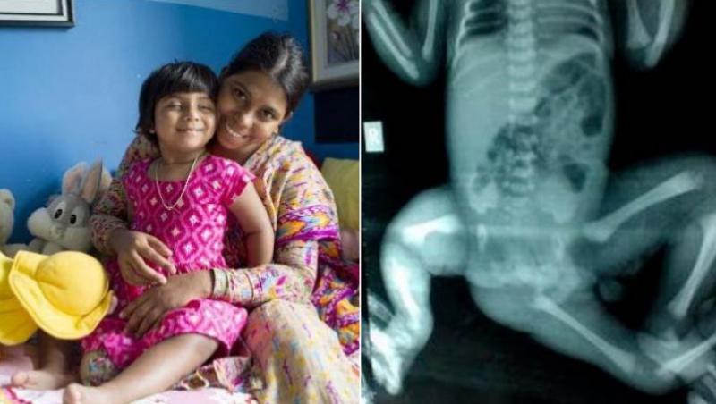O fetiță născută cu trei picioare are acum o șansă la o nouă viață! Avea mai multe organe în dublu exemplar