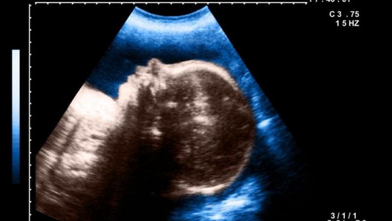 Topul celor mai rare anomalii genetice: de la bebelușul ciclop, la fetița sirenă, adolescentul-lup și tânărul închis într-un circ din cauza figurii înfricoșătoare