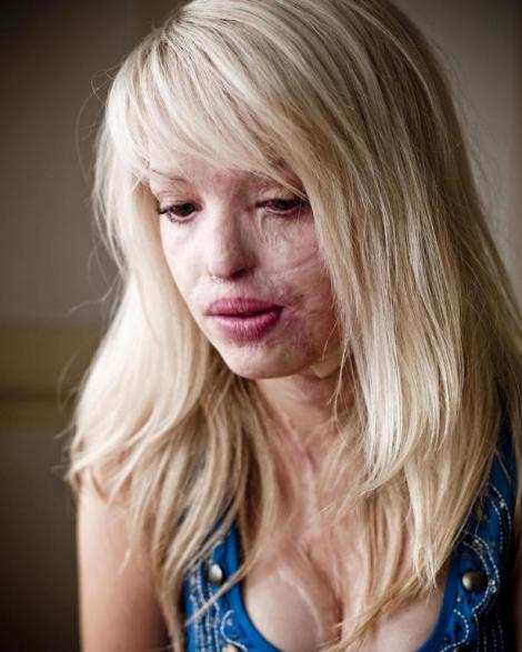 Katie Piper – Povestea uimitoare a supraviețuitoarei unui atac cu acid
