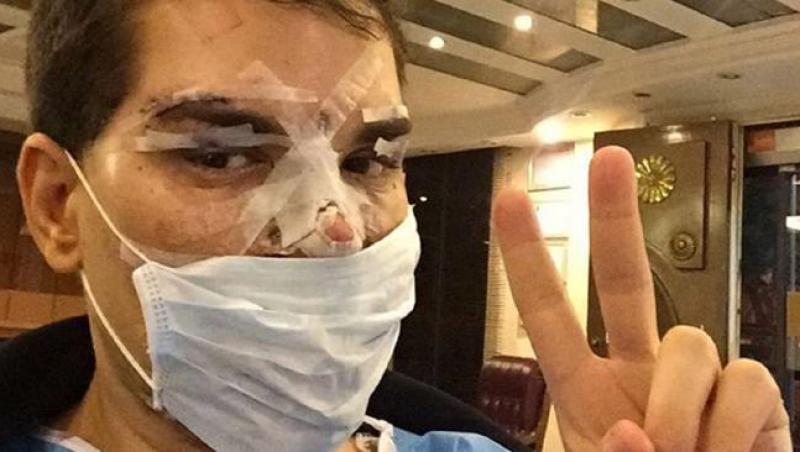 FOTO! 50 de operații estetice are bărbatul care a vrut să arate ca păpușa Ken, iar acum e desfigurat: ”Nasul îi stă să cadă în orice moment!”
