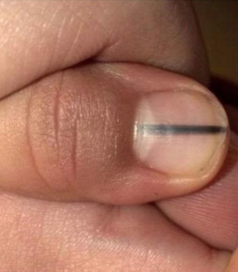 Manichiurista a văzut semnul negru de pe unghia unei cliente și a trimis-o de urgență la spital! Ce veste a primit femeia
