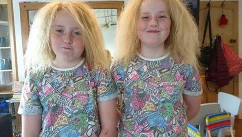 Părinții credeau că au niște gemene obișnuite, până când a început să le crească părul! Cum arată acum cele două fetițe