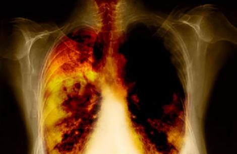 Stai departe de ţigară, te păzeşti de cancer! Fumatul provoacă o schimbare în celulele pulmonare propice tumorilor