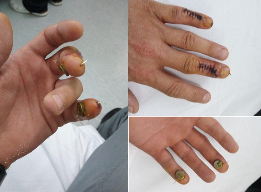 Unul dintre cei mai apreciaţi medici din Rom&acirc;nia i-a operat DEGETUL SĂNĂTOS unui pacient: "Dar nu la cel mijlociu ai probleme?"