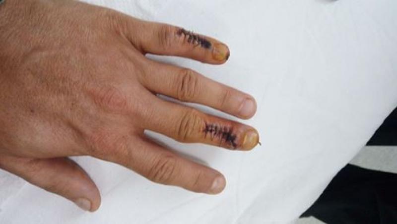 Decizie de ultimă oră în cazul medicului acuzat că a operat un deget greșit! Declarația pacientului, tulburătoare: ”Vai, Batman, m-am dus să mă opereze la degetu' mic şi m-au operat la degetu' mijlociu. Țara lu' Papură-Vodă!”