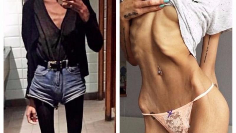 A fost la un pas de moarte din cauza anorexiei! După un an în care s-a ”tratat” cu pizza și s-a transformat uluitor!