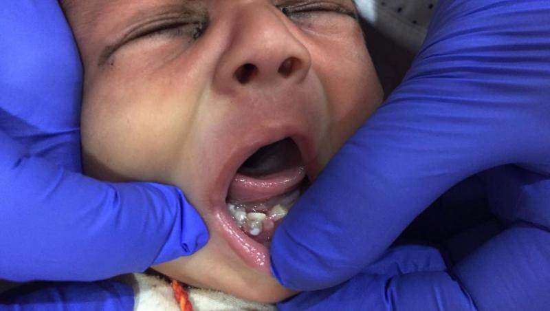 Era ca oricare nou-născut, dar când s-au uitat cu atenție la gurița lui, medicii au încremenit! Cazul este unic în lume! FOTO