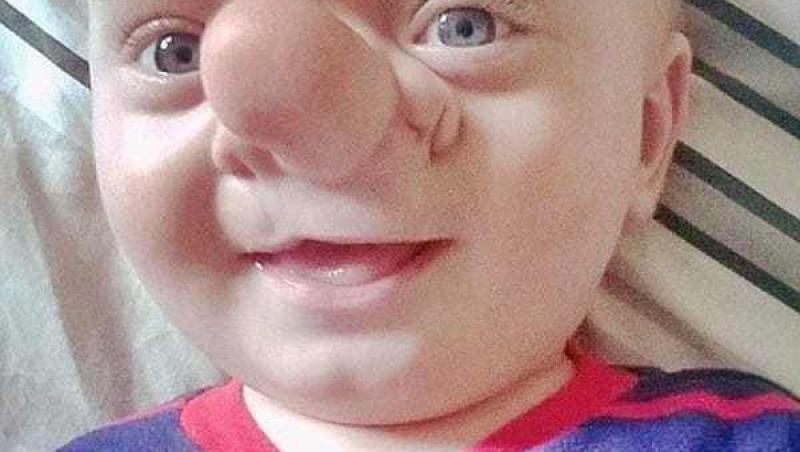 Cu ajutorul medicilor, ”adevăratul Pinocchio” s-a transformat într-un copil normal. Micuţul a trecut prin zeci de operaţii şi a fost ţinta mai multor răutăţi
