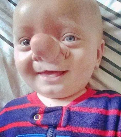 Cu ajutorul medicilor, ”adevăratul Pinocchio” s-a transformat într-un copil normal. Micuţul a trecut prin zeci de operaţii şi a fost ţinta mai multor răutăţi