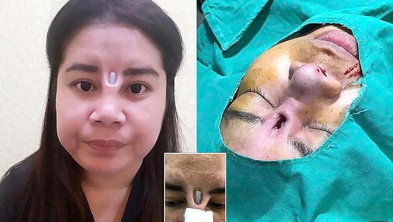 Operațiile plastice au multe riscuri! A vrut să își opereze nasul, dar a ajuns să aibă fața desfigurată. Cum arată acum este strigător la cer