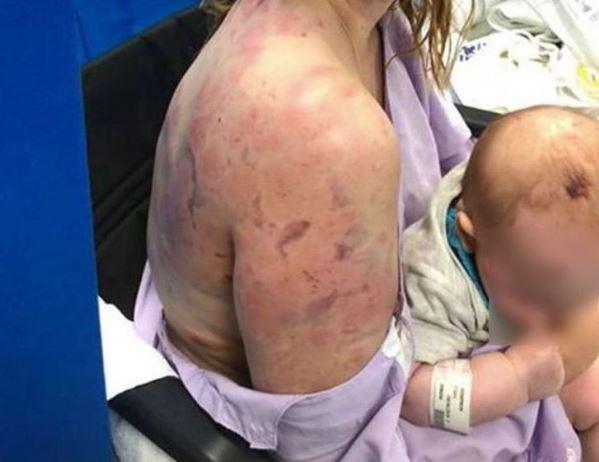 Mama acționează mai ceva ca un scut uman pentru a-și proteja bebelușul de o grindină teribilă. Așa arată tot corpul ei după ce și-a salvat fetița