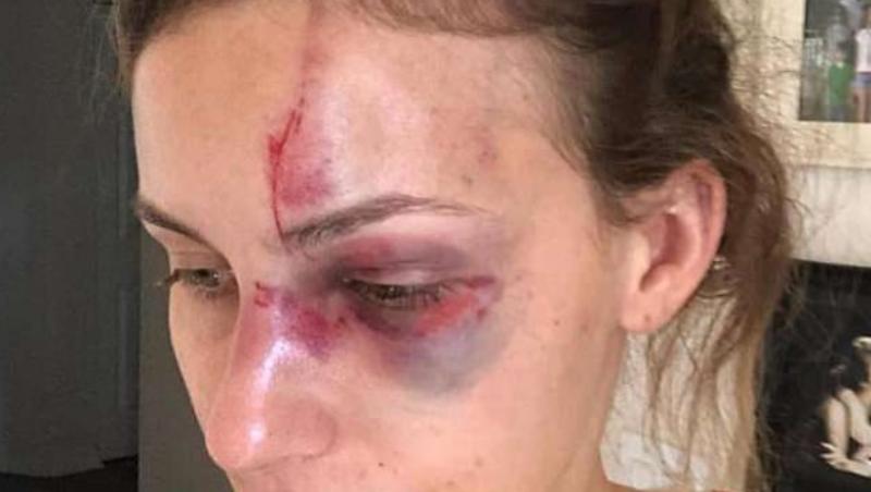 Revoltător! Un sportiv celebru şi-a desfigurat iubita după o postare pe Instagram! Imagini halucinante au fost făcute publice