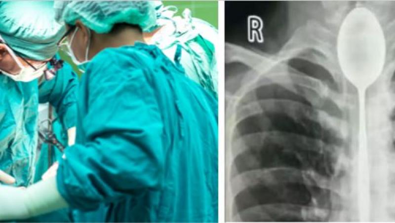 Caz ȘOCANT în lumea medicală! Un bărbat este operat de urgență după ce a stat 1 an de zile cu o lingură înfiptă în gât. Declarația bărbatului a îngrozit medicii