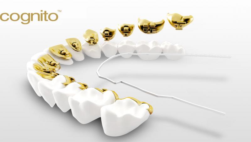 Ce beneficii poate avea purtarea unui aparat dentar asupra stilului tau de viata si a sanatatii orale?
