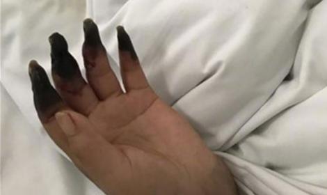 O femeie și-a făcut curățenie în casă, după care i-au putrezit degetele! Greșeala gravă pe care o va regreta toată viața