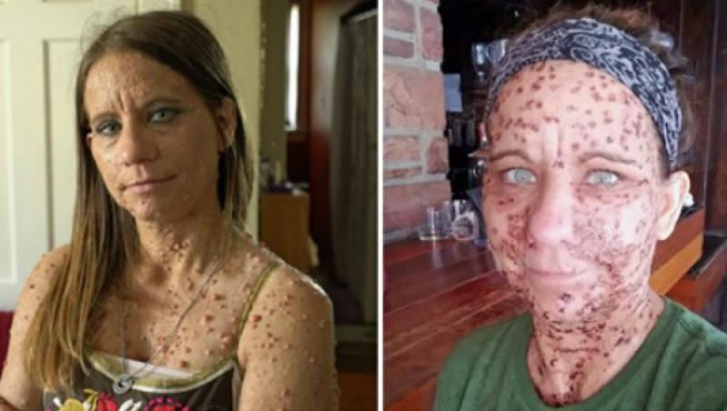 După 40 de ani de trăit în suferință și rușine, femeia de 45 de ani cu peste 6000 de tumori s-a operat. Cum arată acum