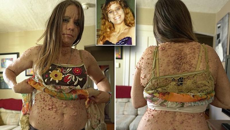 După 40 de ani de trăit în suferință și rușine, femeia de 45 de ani cu peste 6000 de tumori s-a operat. Cum arată acum
