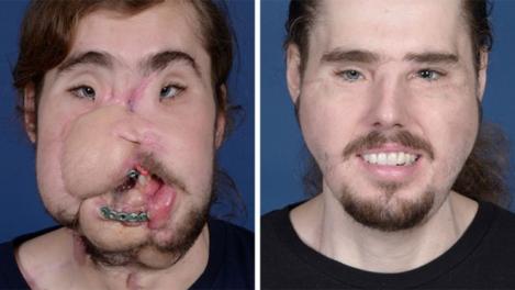 Mărturisirile sfâșietoare ale unui bărbat care a primit un transplant de față: ”Am o gură și un nas. Pot să zâmbesc din nou!”