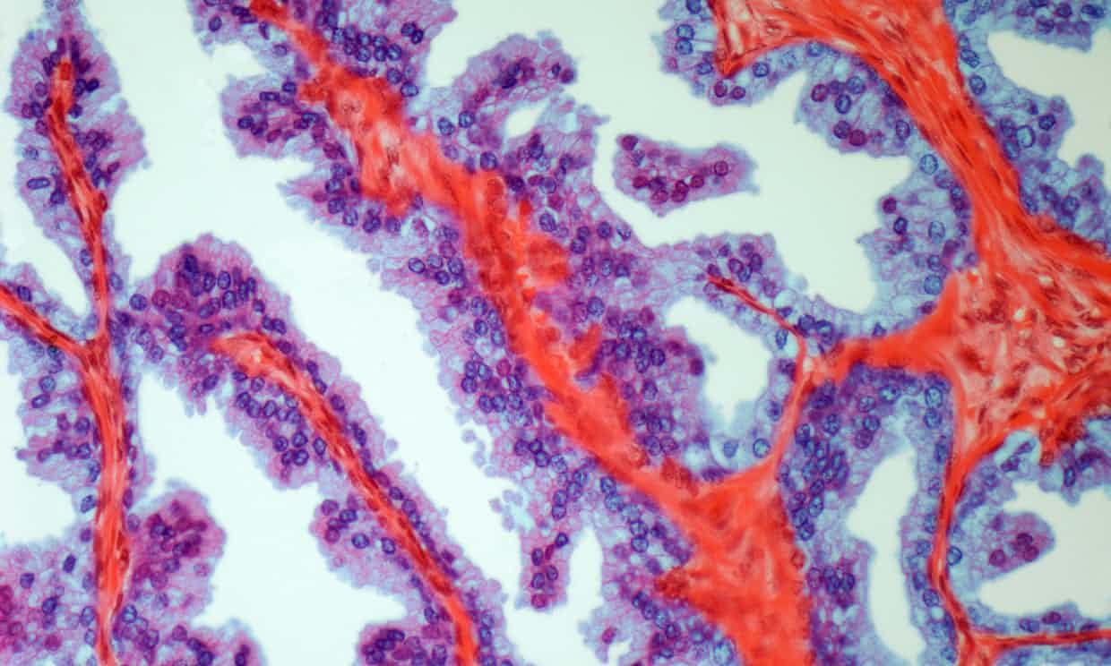 Cancerul de prostată, mai periculos dec&acirc;t cel la s&acirc;n. Vești proaste pentru bărbați