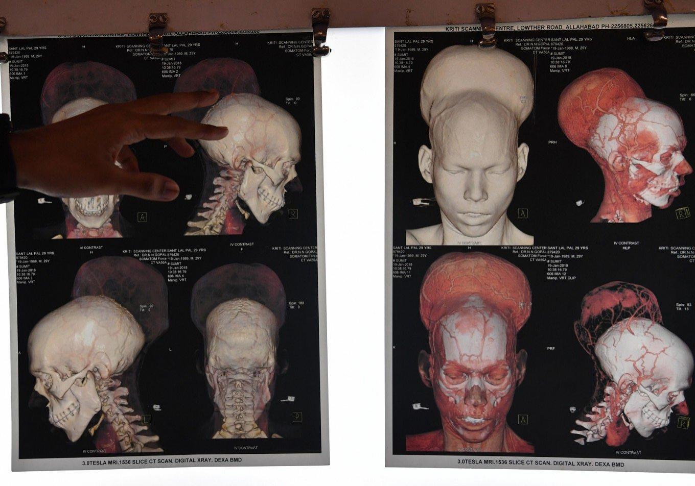 Medicii indieni au &icirc;ndepărtat CEA MAI GRAVĂ TUMOARE din LUME: &ldquo;A fost o procedură maraton &ldquo;