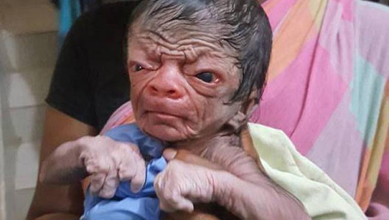 O femeie a născut un bebeluș  care arată precum un bătrân de 80 de ani! Medicii au fost uimiți când l-au văzut pe micuț. GALERIE FOTO