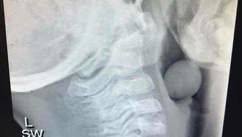 Radiografia de pe Facebook care i-a îngrozit pe părinți! Un bob de strugure în gâtul unui copil de cinci ani
