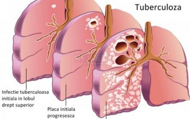 24 MARTIE - Ziua Mondială de Luptă &icirc;mpotriva Tuberculozei. Semnele TBC-ului