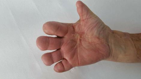 "Regret că nu i-am amputat mâna". Medic, despre o pacientă care nu primeşte pensie de boală, deşi nu îşi poate folosi mâna: "V-au rămas falange la degete! Așa că, asta e!"