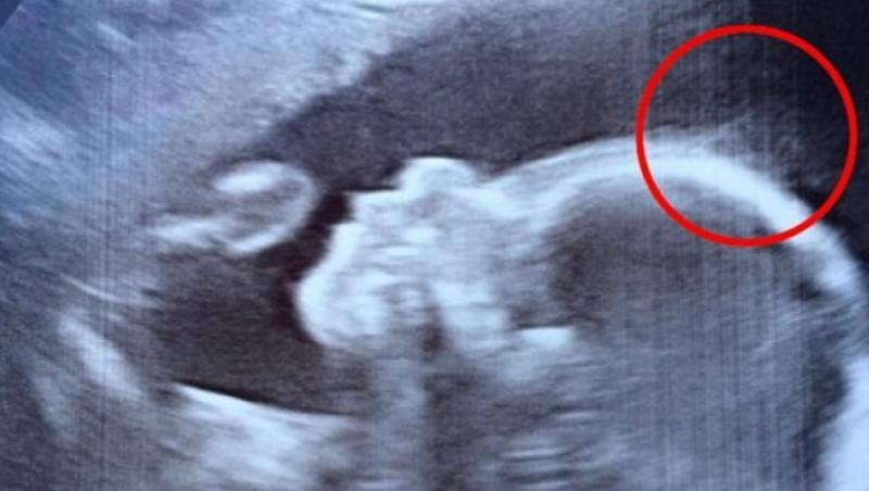 La ecografie, medicii au văzut ceva în jurul capului bebeluşului. Cum arată la câteva luni de la naştere micuţa. Este unică în lume!