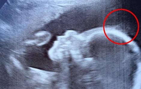 La ecografie, medicii au văzut ceva în jurul capului bebeluşului. Cum arată la câteva luni de la naştere micuţa. Este unică în lume!