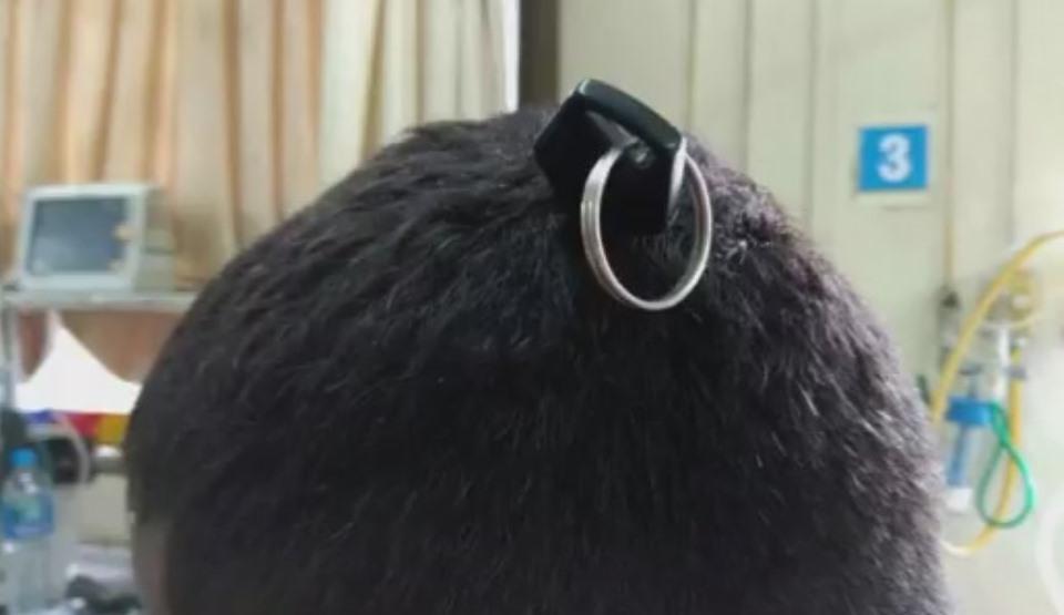 Caz miraculos! Cum a reușit să supraviețuiască un bărbat, cu o cheie &icirc;nfiptă &icirc;n creier: "L-ar fi putut costa viața!"