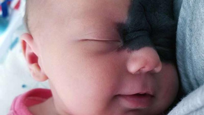 Un bebeluș i-a uimit pe doctori! A venit pe lume cu o pată neagră, care îi acoperă aproape jumătate de față. Părinții: 