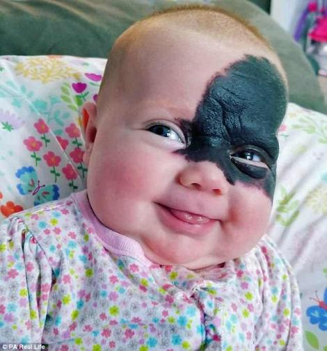 Un bebeluș i-a uimit pe doctori! A venit pe lume cu o pată neagră, care îi acoperă aproape jumătate de față. Părinții: "Îi vom spune că are o mască de super-erou"