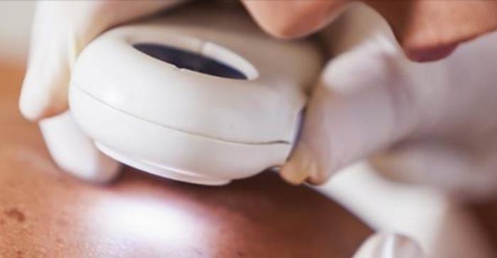 Speranță pentru 10 bolnavi de cancer de piele &icirc;n formă avansată. Ce ajutor vor primi