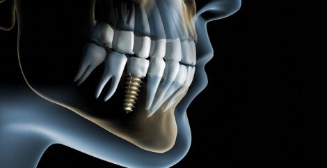 Pret implant dentar versus valoare implant dentar