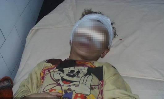 Caz șocant! Copil desfigurat de c&acirc;ine, &icirc;n Vaslui. Părinții au uitat nasul smuls, necesar pentru reconstrucție, pe bancheta mașinii