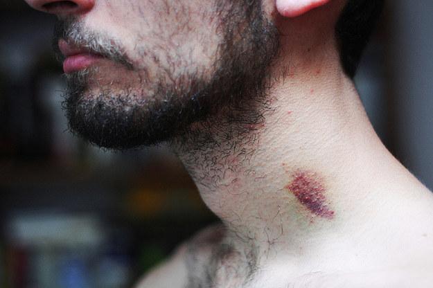 Un t&acirc;năr  de 17 ani a murit la scurt timp după ce iubita sa i-a lăsat aceste urme pe g&acirc;t! Medicii au dat verdictul