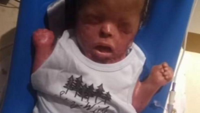 S-a năcut fără piele pe tot corpul iar medicii nu-i dădeau nici o șansă! Un bebeluș a luptat până în ultima clipă pentru a fi alături de mama lui: „Dacă nu ar fi avut scopul său de a fi aici, ar fi fost plecat de la naștere”