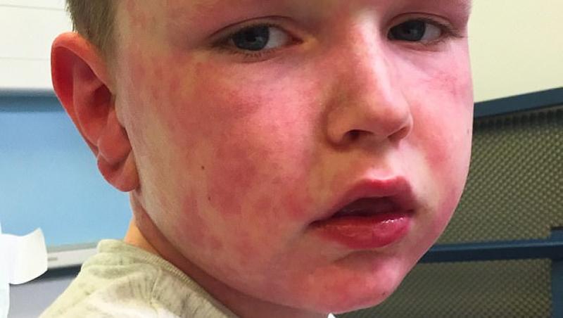 Copilul care este alergic la iarnă. Cum reacționează când îi este frig. Medicii sunt șocați! FOTO