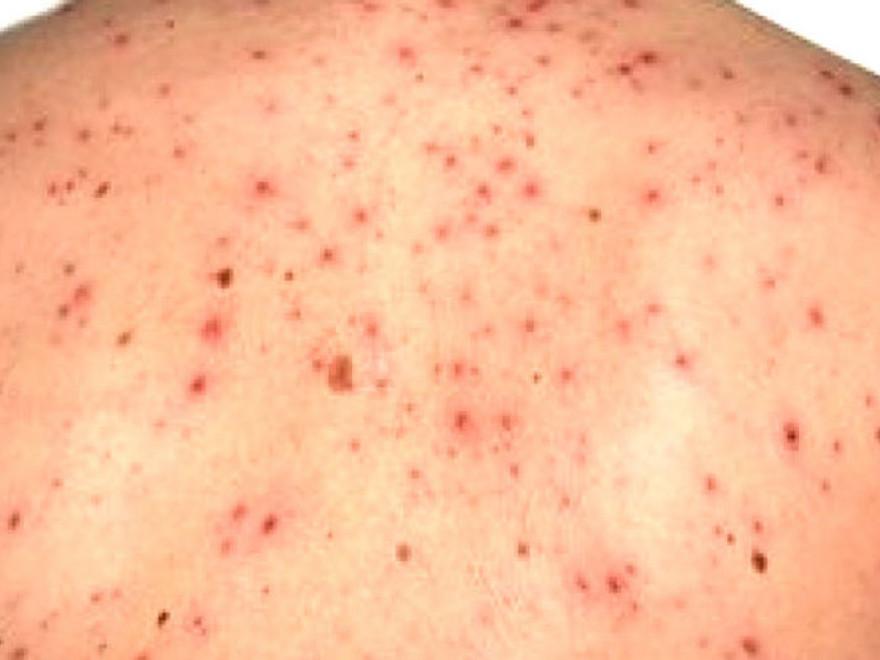 Alertă de rujeolă &icirc;n Rom&acirc;nia! Unde au fost raportate alte 60 de cazuri nou-confirmate