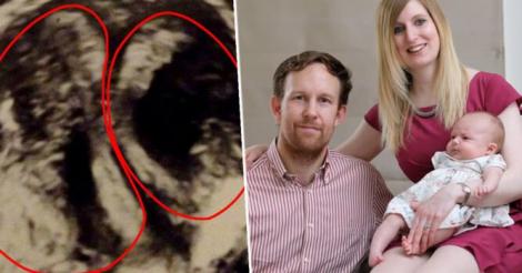 A primit șanse de 1% de a rămâne însărcinată însă a uimit știința! O femeie a reușit să dea naștere unui copil având doua vagine, două coluri uterine și două utere! Doctorii au rămas șocați