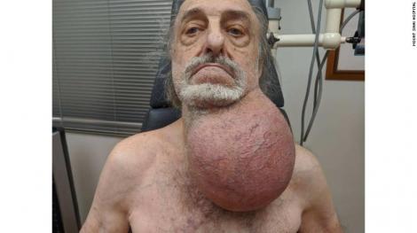 Medicii au rămas fără cuvinte! Un bărbat a ajuns la spital cu o tumoare de dimensiunea unei mingi de fotbal. „M-am pregătit pentru cel mai rău scenariu”