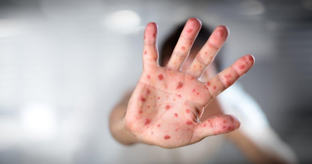 Medicii sunt &icirc;n alertă. &Icirc;n ultima săptăm&acirc;nă s-au confirmat 17 cazuri de rujeolă &icirc;n șase județe