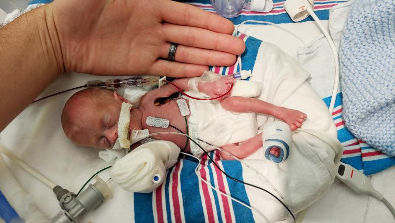 Un bebeluș născut prematur, cu doar 311 grame (Statele Unite ale Americii)