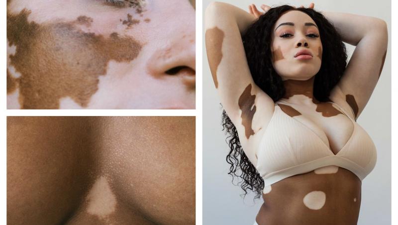 Vitiligo este o afecțiune (boală) care duce la distrugerea sau slăbirea melanocitelor, acele celule pigmentare responsabile de culoarea pielii, ceea ce duce la pierderea sau oprirea producerii pigmentului și la apariția de pete albe pe suprafața pielii.