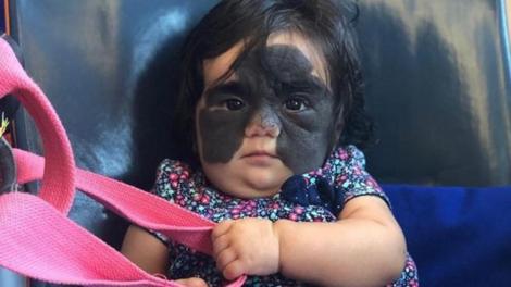 O fetiță de opt luni suferă de cea mai neobișnuită boală! Aceasta are o aluniță care se întinde pe toată fața - FOTO